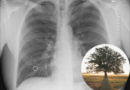 Weird News: Small tree found growing inside Russian man's lung (Video) – The South African