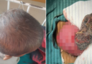 Stunned doctors find huge hair ball with 'tail' in four-year-old girl's stomach – The Mirror